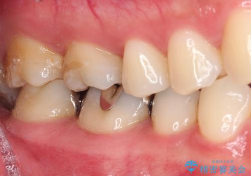 銀歯をセラミックにしたい セラミックインレー修復の治療前