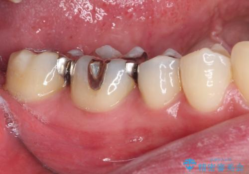 銀歯をセラミックにしたい セラミックインレー修復の治療前