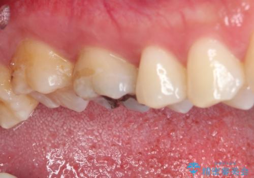 銀歯をセラミックにしたい セラミックインレー修復の治療前