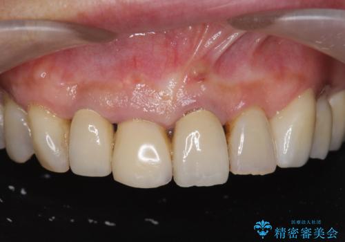 ぐらつく前歯 ブリッジ治療の症例 治療前