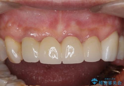 ぐらつく前歯 ブリッジ治療の治療後