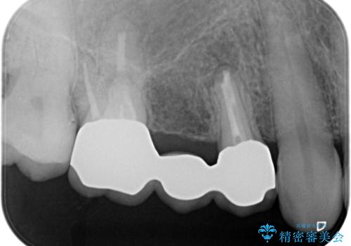 【歯根端切除術】根っこの治療をしたが、また腫れてきた。の治療後