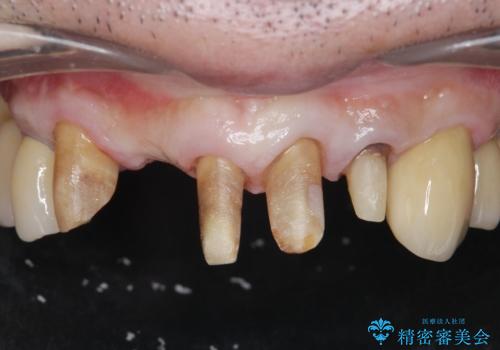 歯周病治療を伴う前歯審美セラミック治療の治療中