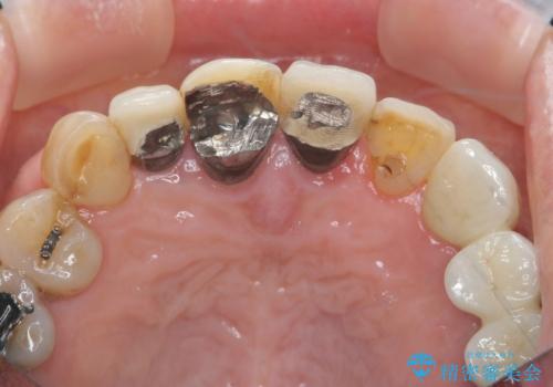 ぐらつく前歯 ブリッジ治療の治療前