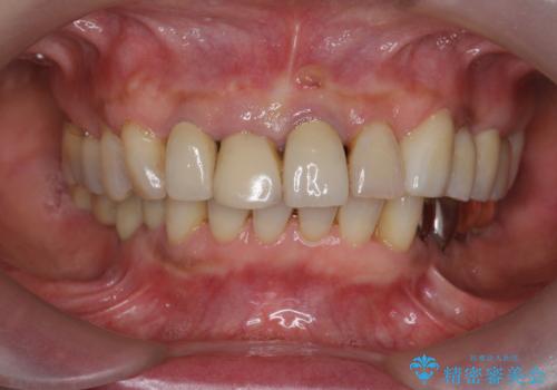 ぐらつく前歯 ブリッジ治療の治療前