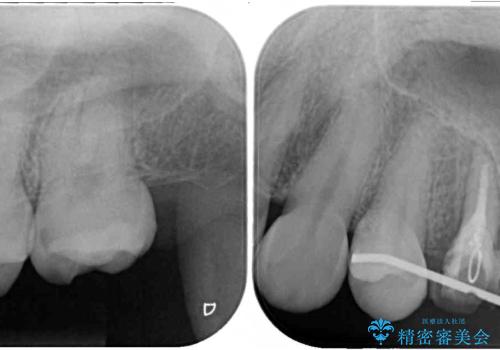 抜歯と言われた歯を残したい 部分矯正と外科処置を用いた補綴治療の治療中