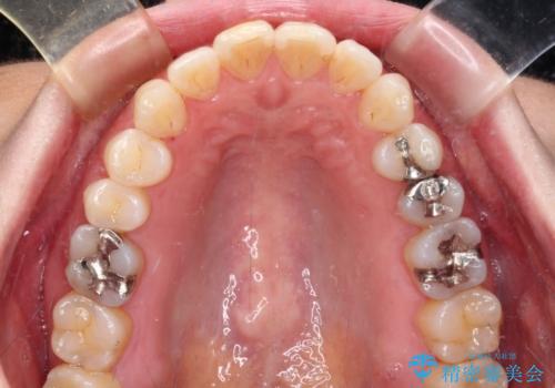 銀歯をセラミックにしたい セラミックインレー修復の治療前