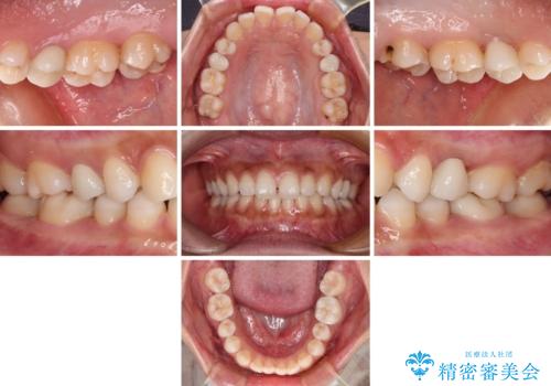 抜歯と言われた歯を残したい 部分矯正と外科処置を用いた補綴治療の治療後