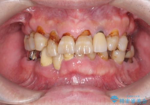 歯周病治療を伴う前歯審美セラミック治療の治療前