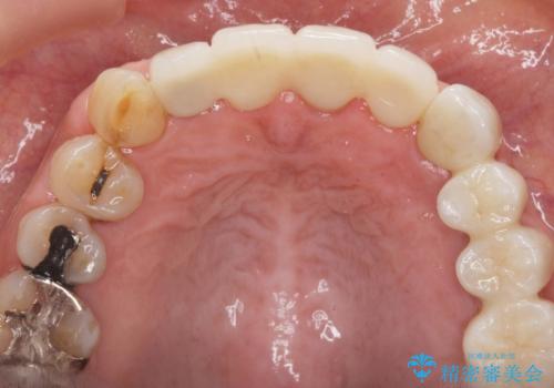 ぐらつく前歯 ブリッジ治療の治療後