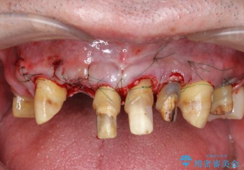 歯周病治療を伴う前歯審美セラミック治療の治療後