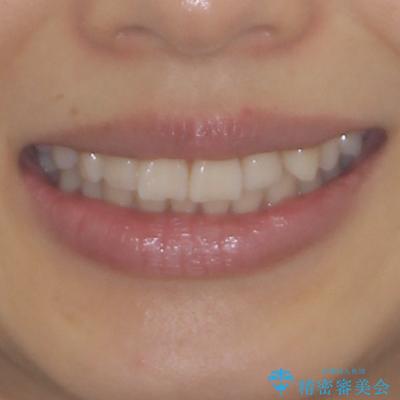 前にずれた咬み合わせをワイヤー装置でしっかりと改善の治療前(顔貌)