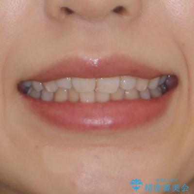 抜歯矯正の後戻り インビザライン・ライトによる矯正治療の治療前(顔貌)