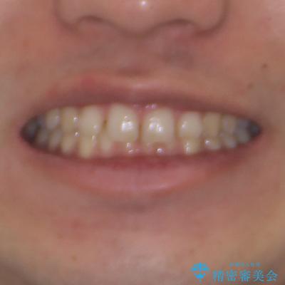 深い咬み合わせと隙間の空いた歯列をワイヤー矯正で改善の治療前（顔貌）