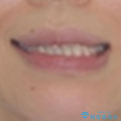 受け口傾向の歯並びをインビザラインで改善の治療前（顔貌）