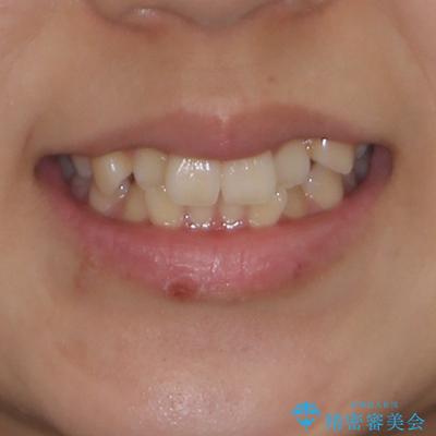 デコボコと八重歯の目立つ前歯　ワイヤー装置による抜歯矯正の治療前（顔貌）