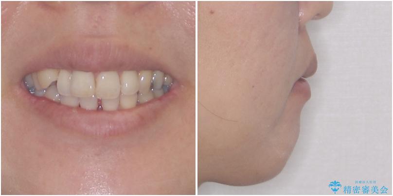 閉じにく口元と欠損歯列　ワイヤー装置の抜歯矯正の治療前（顔貌）