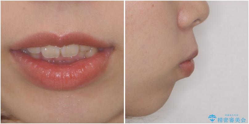 目立たない装置で出っ歯を治したい ハーフリンガル矯正の治療前(顔貌)