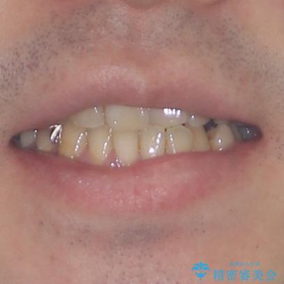 欠損のある歯列　インビザラインで整った歯並びにの治療前（顔貌）
