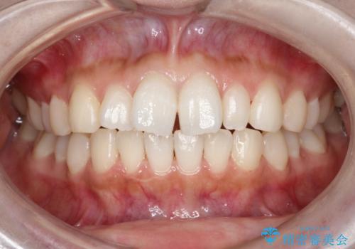【インビザライン】矮小歯を有する方の治療②の症例 治療前