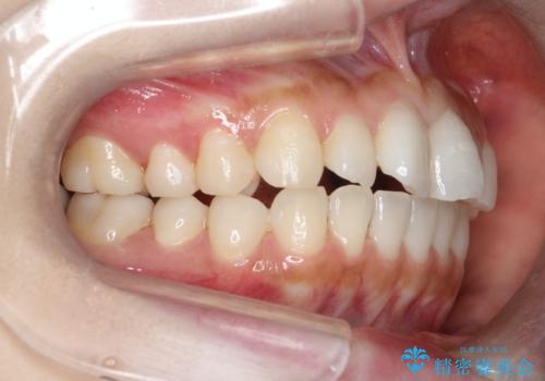 【インビザライン】矮小歯を有する方の治療②の治療前