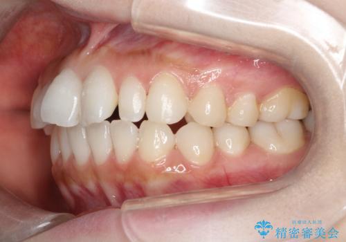 【インビザライン】矮小歯を有する方の治療②の治療前