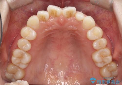 【インビザライン】矮小歯を有する方の治療②の治療前
