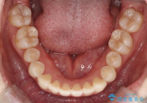 【インビザライン】矮小歯を有する方の治療②の治療前