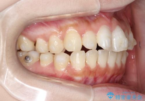 【インビザライン】矮小歯を有する方の治療②の治療中