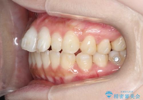 【インビザライン】矮小歯を有する方の治療②の治療中