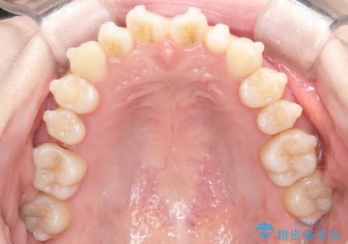 【インビザライン】矮小歯を有する方の治療②の治療中