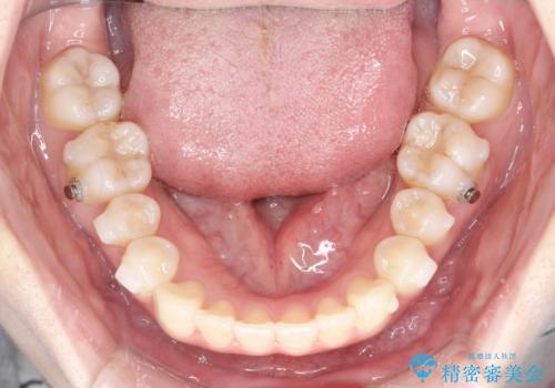 【インビザライン】矮小歯を有する方の治療②の治療中