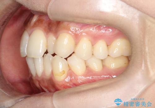 【インビザライン】矮小歯を有する方の矯正治療の治療前