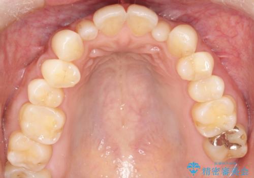 【インビザライン】矮小歯を有する方の矯正治療の治療前