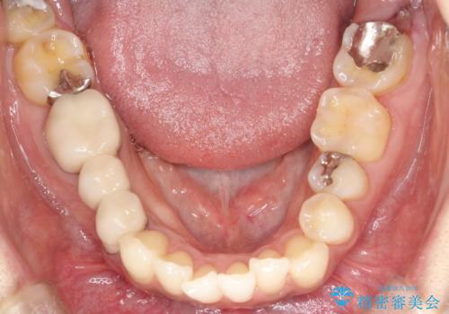 【インビザライン】矮小歯を有する方の矯正治療の治療前