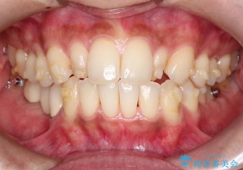 【インビザライン】矮小歯を有する方の矯正治療の治療中