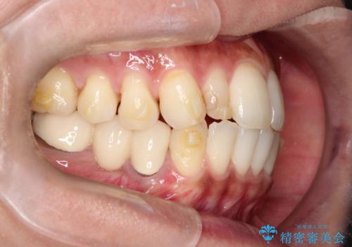 【インビザライン】矮小歯を有する方の矯正治療の治療中
