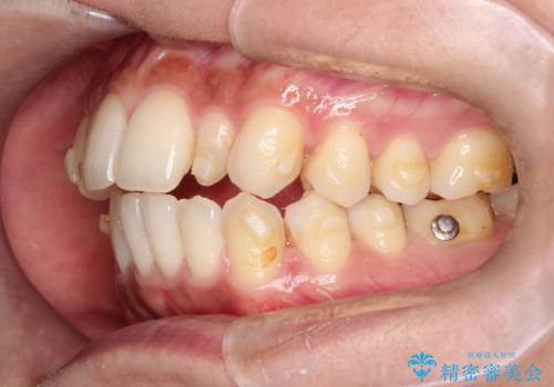 【インビザライン】矮小歯を有する方の矯正治療の治療中