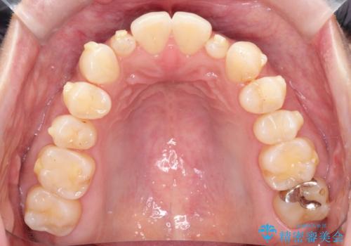 【インビザライン】矮小歯を有する方の矯正治療の治療中