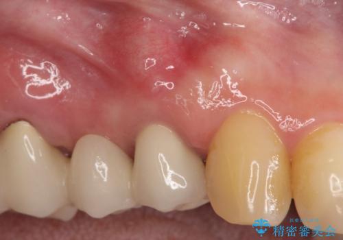 【歯根端切除術】根っこの治療をしたが、また腫れてきた。の治療前