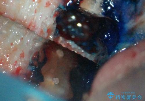 【歯根端切除術】根っこの治療をしたが、また腫れてきた。の治療中