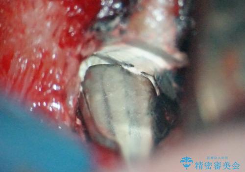 【歯根端切除術】根っこの治療をしたが、また腫れてきた。の治療中