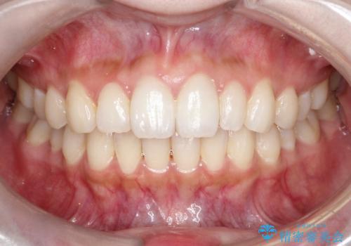 【インビザライン】矮小歯を有する方の治療②の症例 治療後