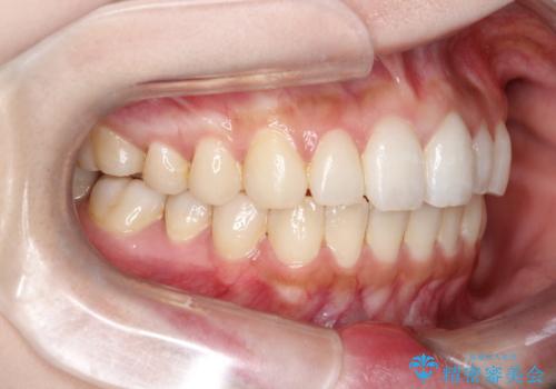 【インビザライン】矮小歯を有する方の治療②の治療後