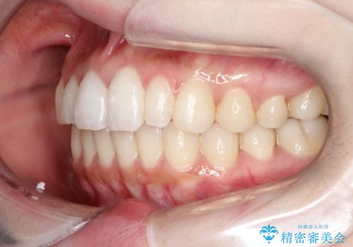 【インビザライン】矮小歯を有する方の治療②の治療後