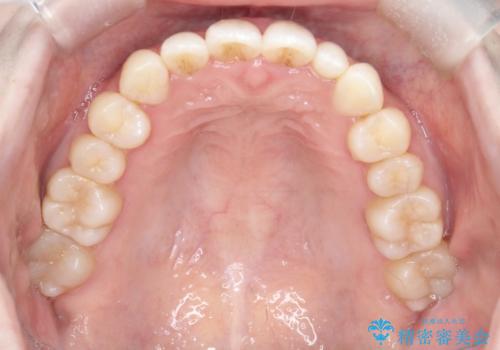 【インビザライン】矮小歯を有する方の治療②の治療後
