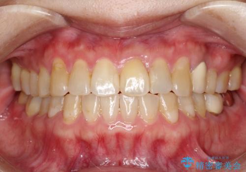 【インビザライン】前歯のガタガタを治したい