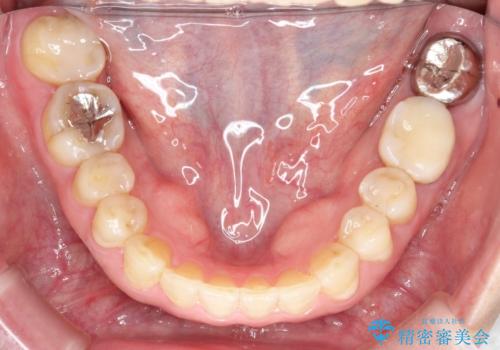 【インビザライン】前歯のガタガタを治したいの治療後
