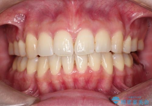 【審美ワイヤー装置】前歯を噛ませたいの症例 治療後