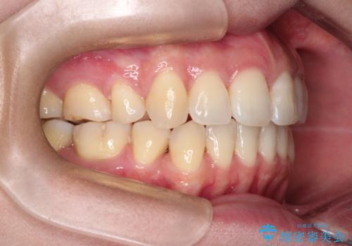 【審美ワイヤー装置】前歯を噛ませたいの治療後